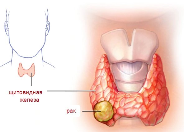 Рак щитовидной железы — симптомы, диагностика, лечение